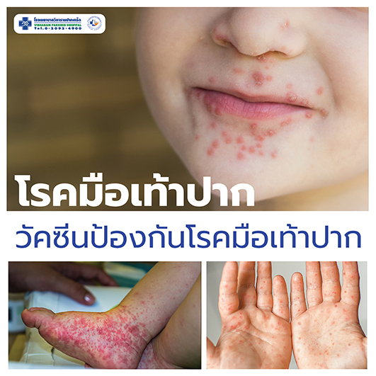 โรคมือเท้าปาก วัคซีนป้องกันโรคมือเท้าปาก โดย ยงภู่วรวรรณ  ราชบัณฑิต